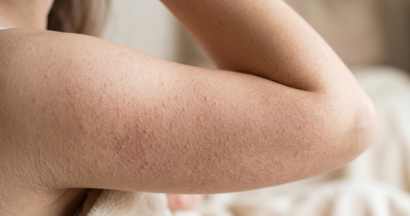 chicken skin keratosis pilaris