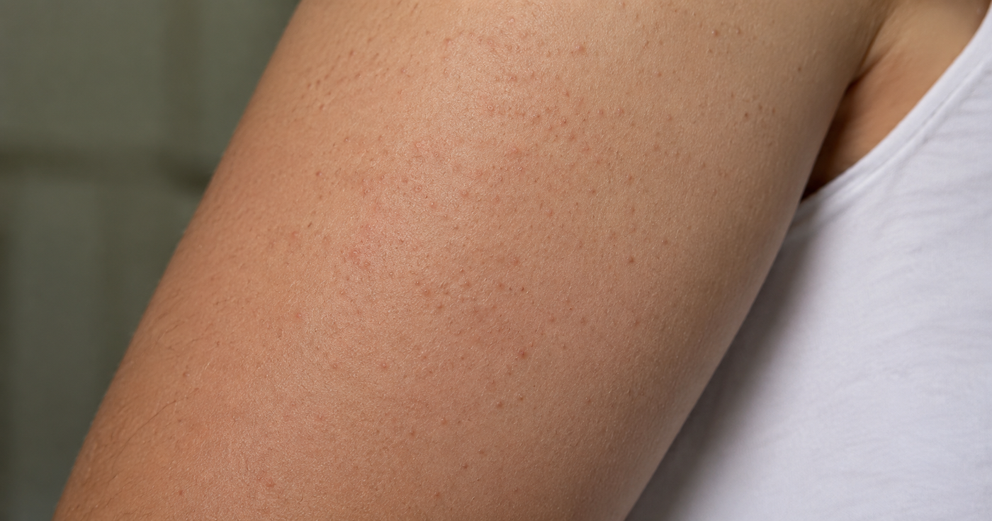 Understanding “Strawberry Skin” aka Keratosis Pilaris