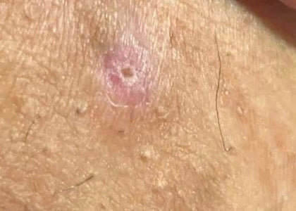 Stage 3 – Protects Stage 3 – Protects