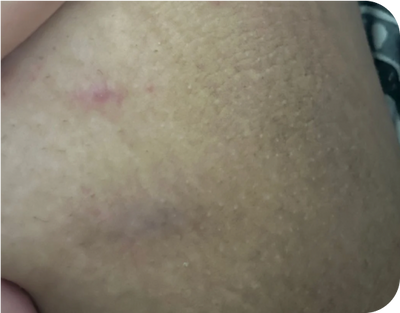 1. Flare Ups - after 1. Flare Ups - after