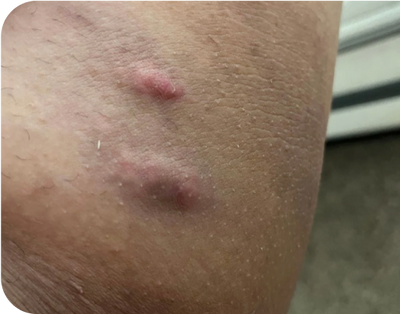 1. Flare Ups - before 1. Flare Ups - before