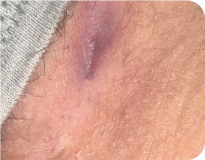 3. Lesions - after 3. Lesions - after