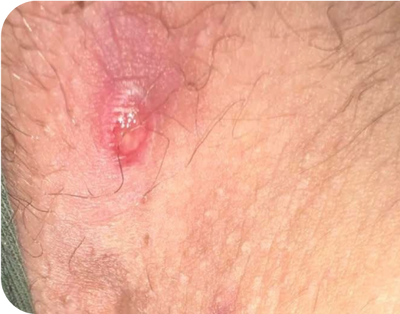 3. Lesions - before 3. Lesions - before