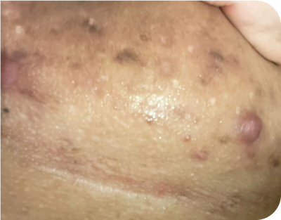 4. Scarring - after 4. Scarring - after