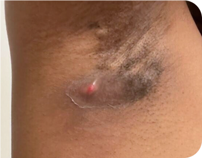 5. Boils - after 5. Boils - after