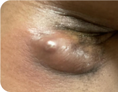 5. Boils - before 5. Boils - before