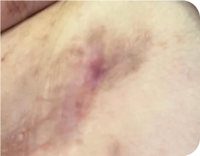 6. Pustules - after 6. Pustules - after