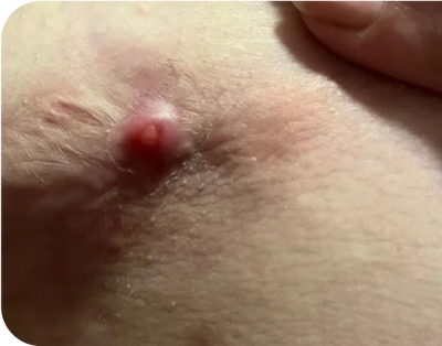 6. Pustules - before 6. Pustules - before