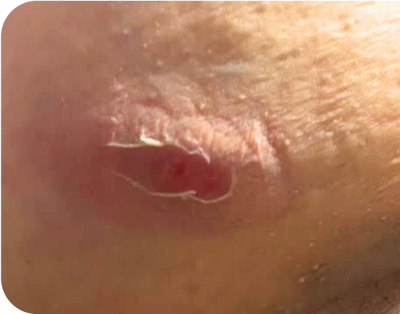 7. Open Sores - before 7. Open Sores - before