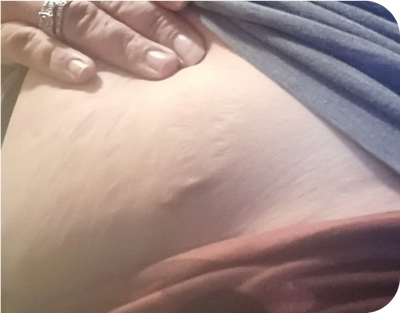 8. Abscesses - after 8. Abscesses - after