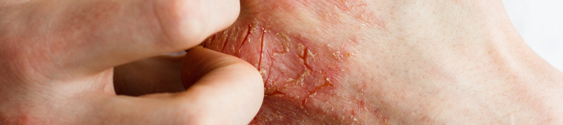 Finally! A Natural Eczema Solution That Works Finally! A Natural Eczema Solution That Works