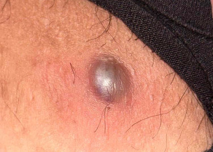 Stage 1 – Relieves Pain Stage 1 – Relieves Pain