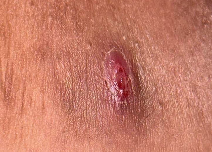 Stage 2 – Calms Stage 2 – Calms