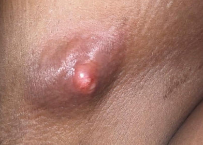 Stage 1 – Relieves Pain Stage 1 – Relieves Pain