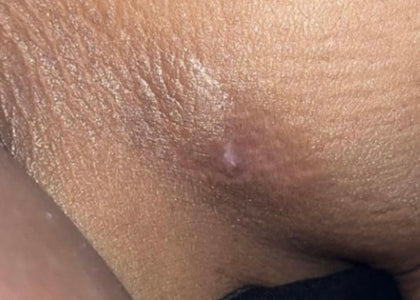 Stage 3 – Protects Stage 3 – Protects