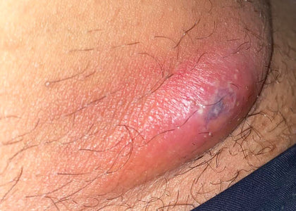 Stage 1 – Relieves Pain Stage 1 – Relieves Pain