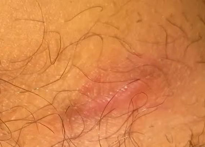 Stage 3 – Protects Stage 3 – Protects