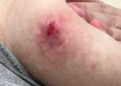 Stage 1 – Relieves Pain Stage 1 – Relieves Pain