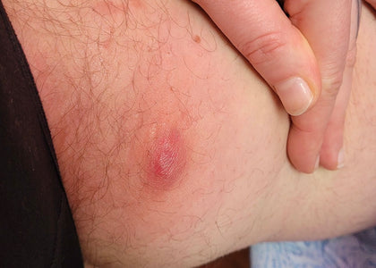 Stage 1 – Relieves Pain Stage 1 – Relieves Pain