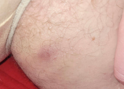 Stage 3 – Protects Stage 3 – Protects