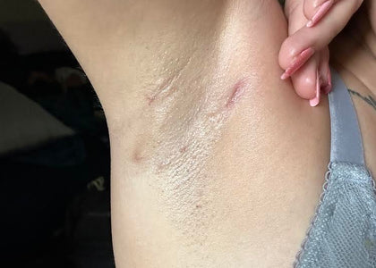 Stage 3 – Protects Stage 3 – Protects