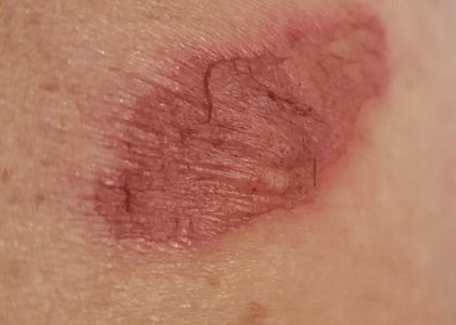 Stage 1 – Relieves Pain Stage 1 – Relieves Pain