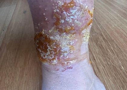 Stage 1 – Relieves Pain Stage 1 – Relieves Pain