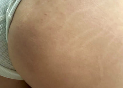 Stage 3 – Protects Stage 3 – Protects