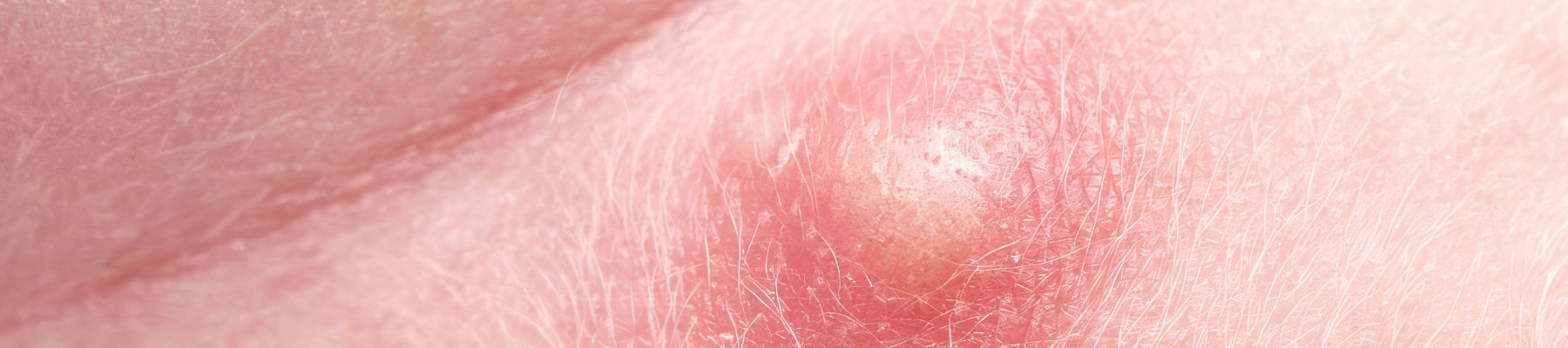 Your Guide to Healing Pilonidal Cysts Your Guide to Healing Pilonidal Cysts