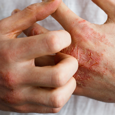 Finally! A Natural Eczema Treatment That Works