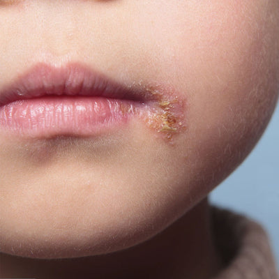 How to Heal Impetigo?