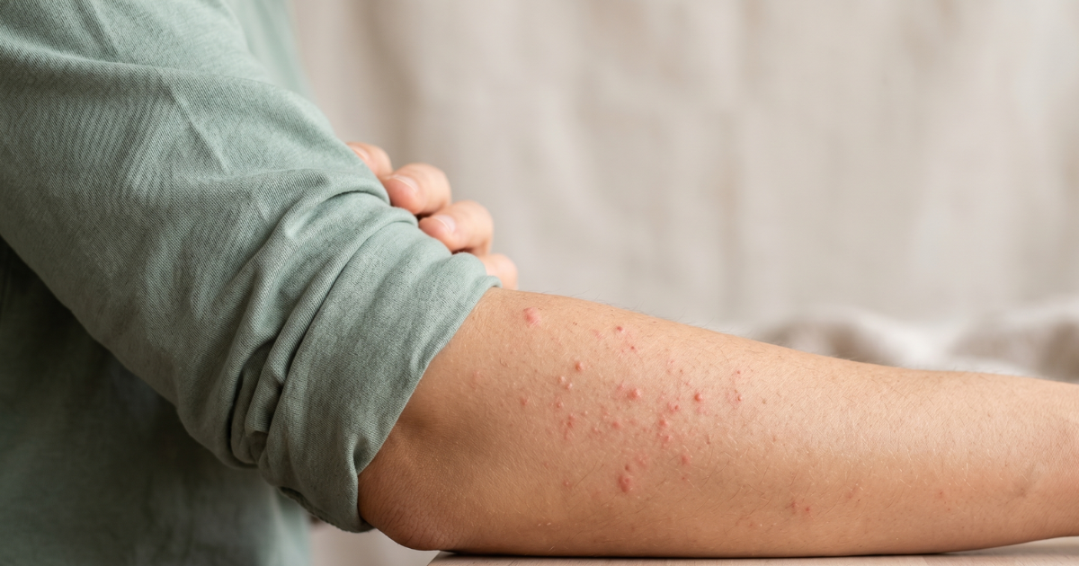 Itchy Red Bumps That Keep Coming Back on Irritated Skin – MyMagicHealer