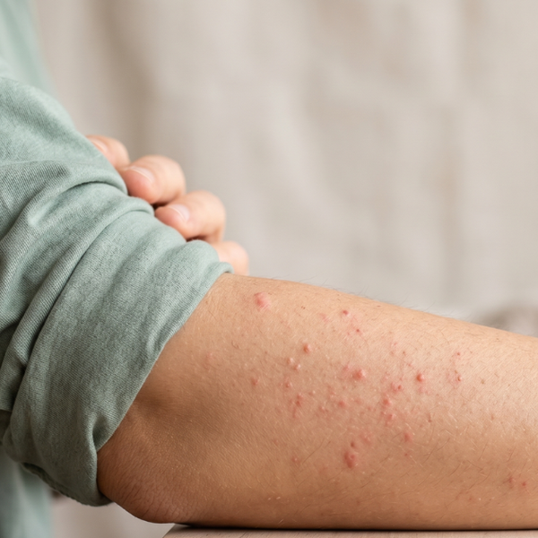 Itchy Red Bumps on Skin – Potential Causes
