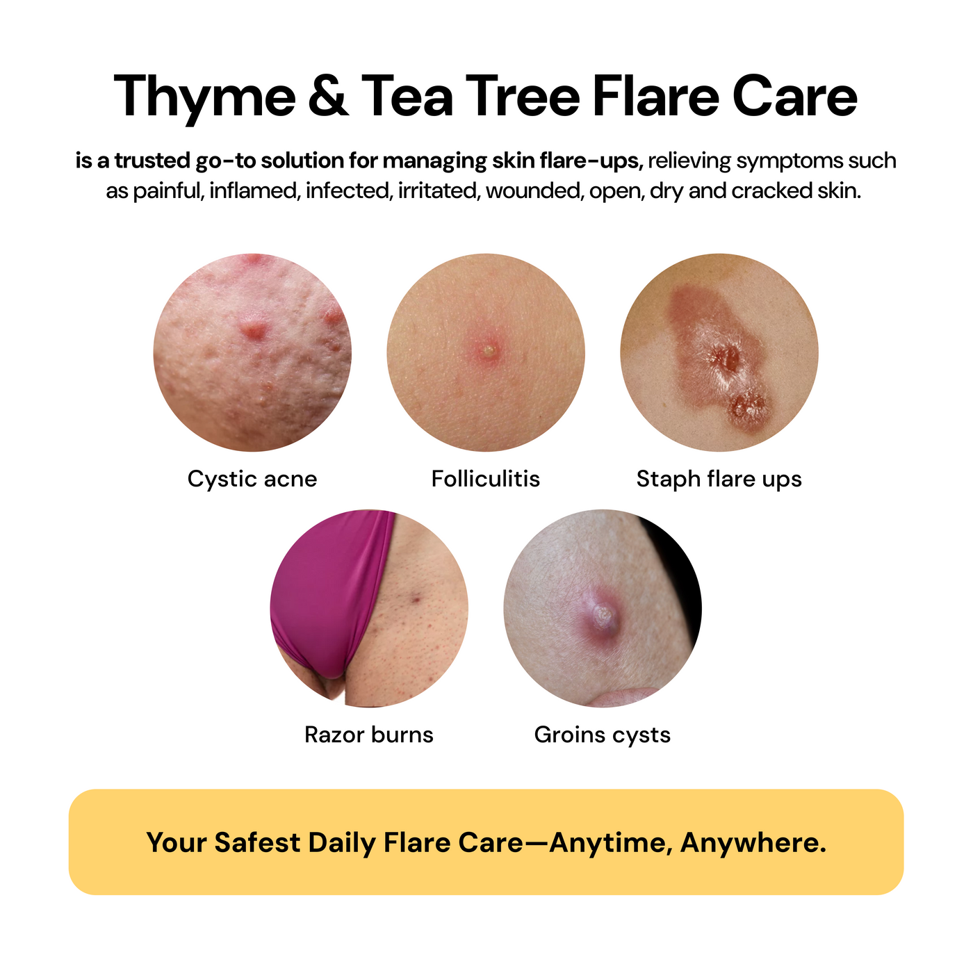 Thyme & Tea Tree Flare Care