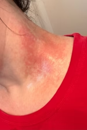 Your skin gets red or irritated quickly