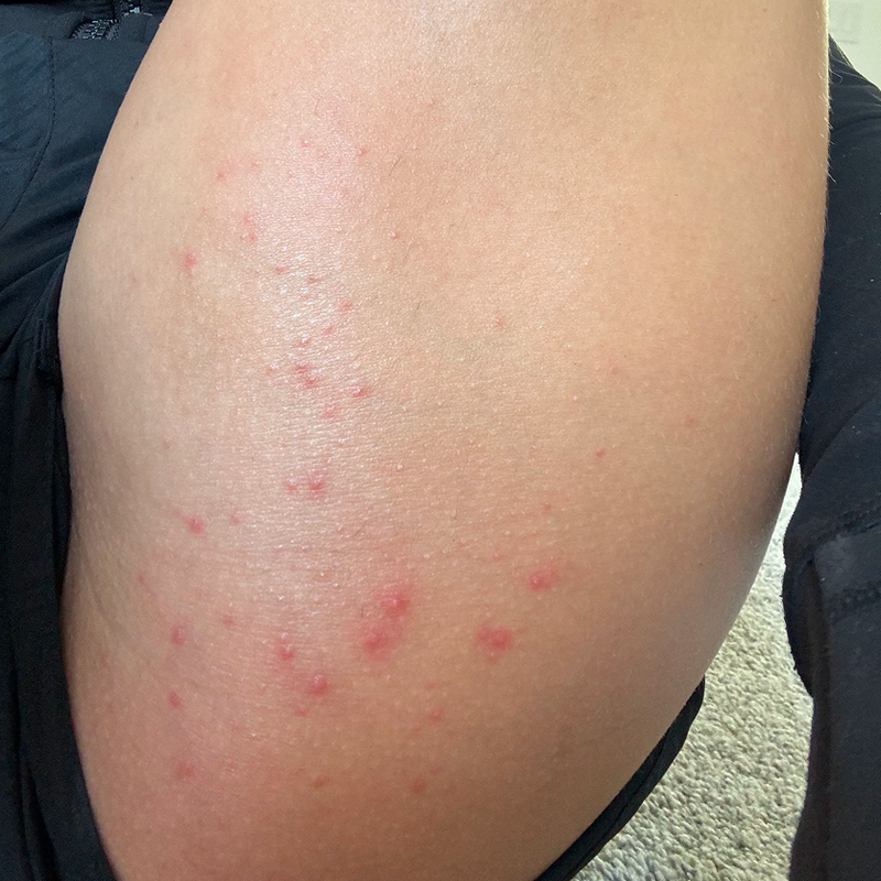 folliculitis