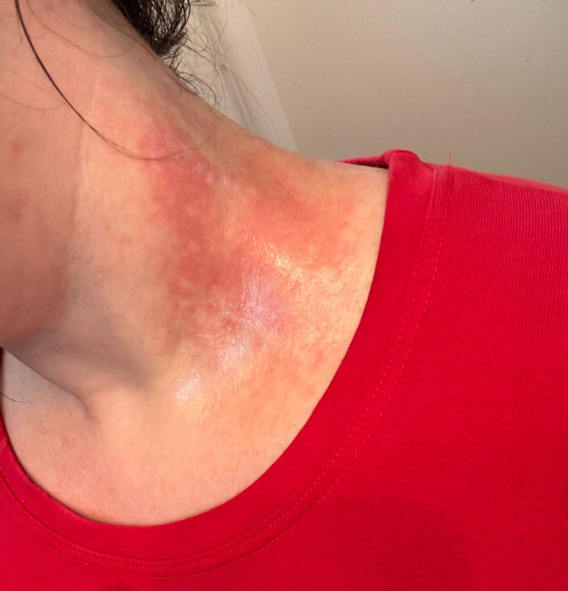 Your skin feels itchy, stingy, or burning