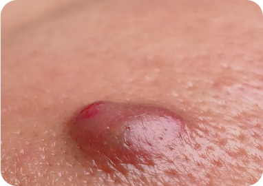 CYSTS