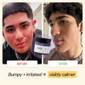Teen Skin Flare Care Routine