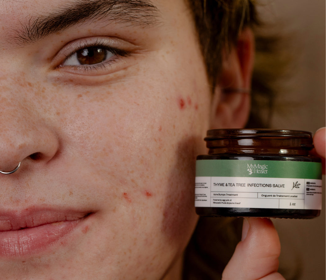 Thyme & Tea Tree Infections Salve | Acne Bumps Treatment