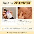 2-Step Acne Routine