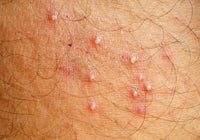 FOLLICULITIS