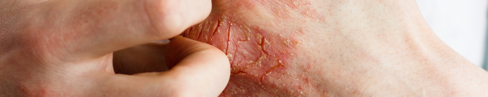 Finally! A Natural Eczema Solution That Works