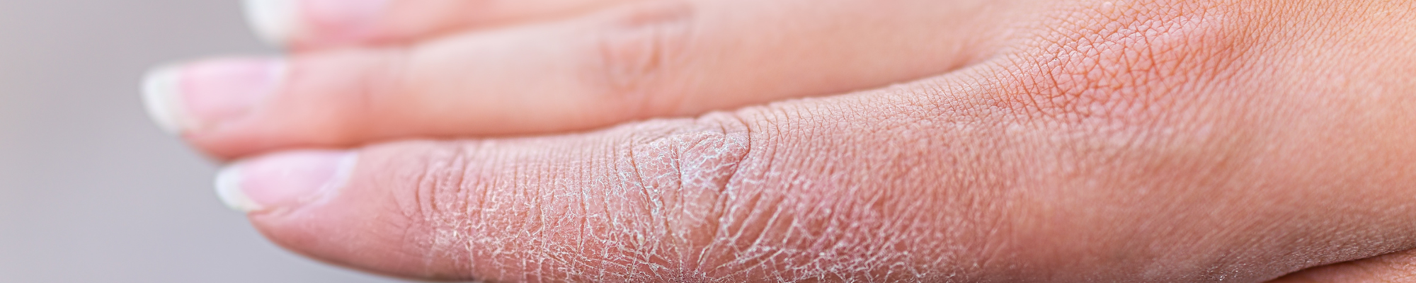 Soothing Eczema Naturally with Universal Flare Care | Essential Oil-Fr